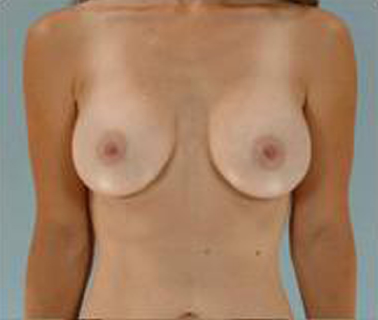 breast implant after