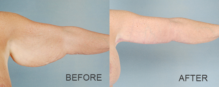 Before and After Brachioplasty