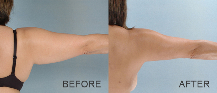 Before and After Arm Liposuction
