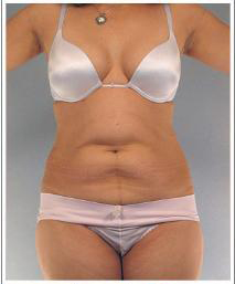 Tummy tuck before image