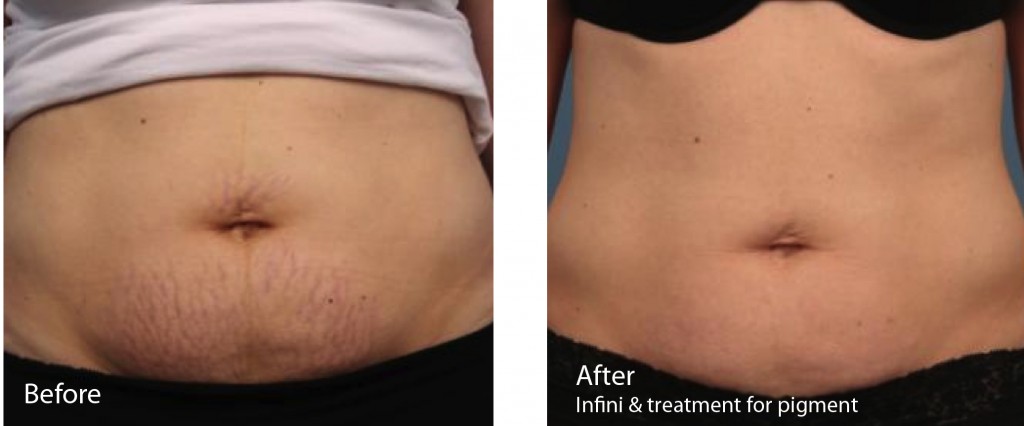 Before and After Infini treatment