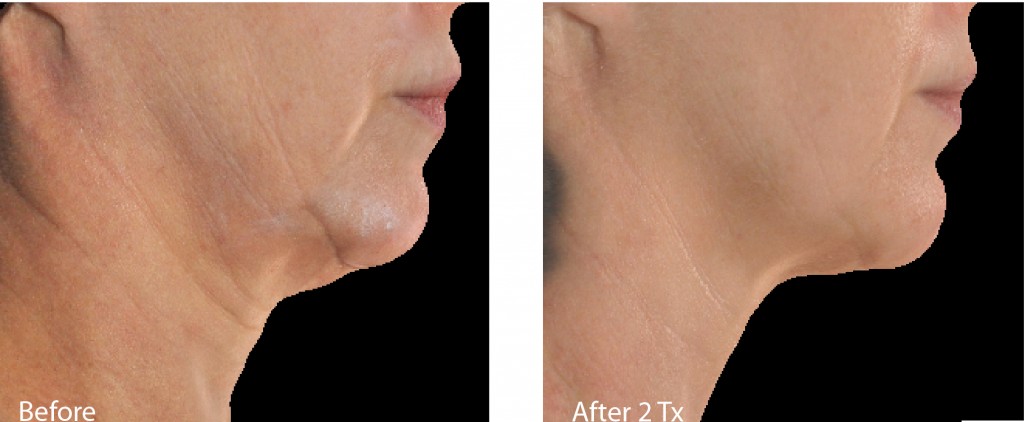 Before and After Infini treatment on face