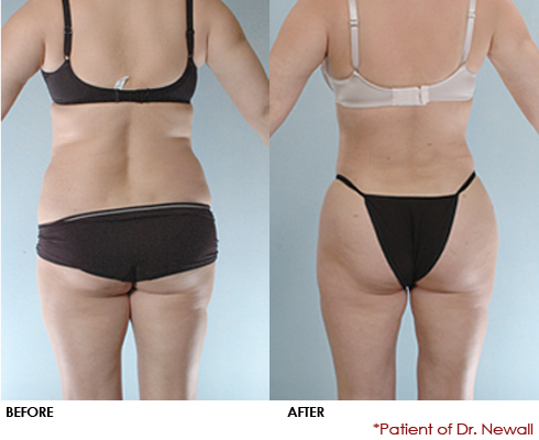 Fat Transfer before and after