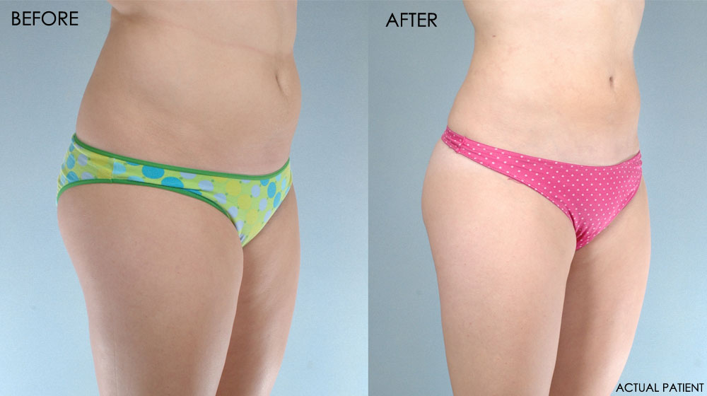 Before and After thigh liposuction