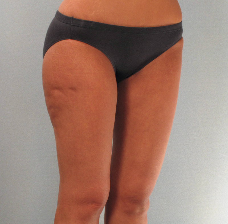 Liposuction thighs