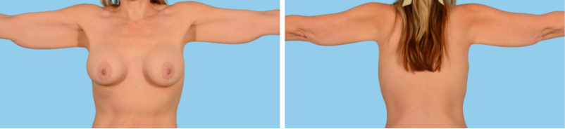 Arm procedures: Bra must be removed, and hair must be pushed back or pulled up in a ponytail