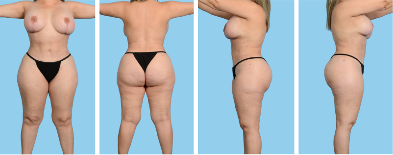 Body contouring procedures (abdomen, back, buttocks, hips): Bra must be removed, and only underwear should be worn.
