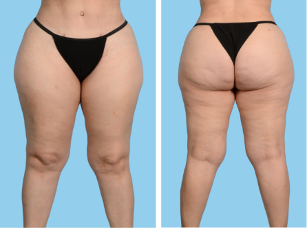Leg procedures: Only underwear should be worn