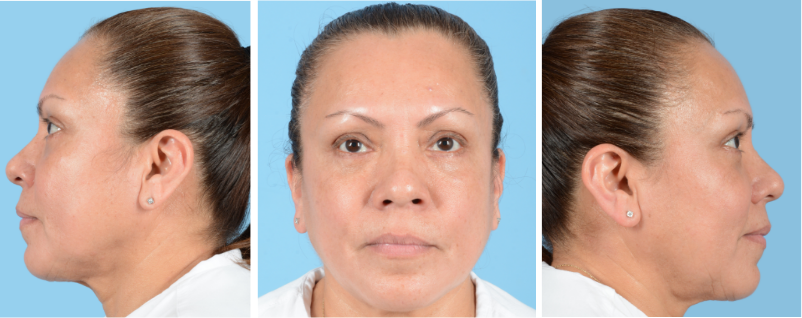 Face, neck, and eyelid procedures: Hair must be pushed back with a headband or pulled up in a ponytail