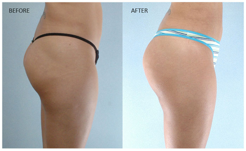 Brazilian Butt Lift Before and After Pictures Houston, TX