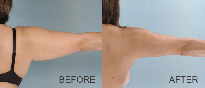 Arm Liposuction Before and After Pictures Houston, TX