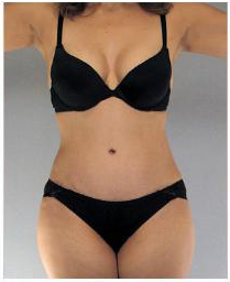 Tummy Tuck Before and After Pictures Houston, TX