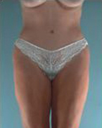 Tummy Tuck Before and After Pictures Houston, TX