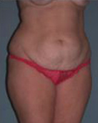 Tummy Tuck Before and After Pictures Houston, TX