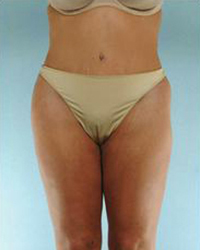 Tummy Tuck Before and After Pictures Houston, TX