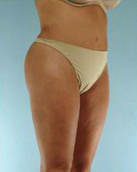 Tummy Tuck Before and After Pictures Houston, TX