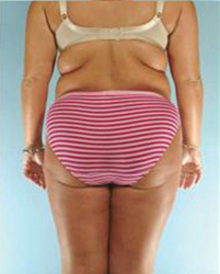 Tummy Tuck Before and After Pictures Houston, TX