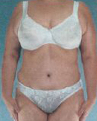 Tummy Tuck Before and After Pictures Houston, TX
