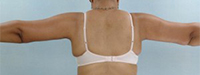 Brachioplasty Before and After Pictures Houston, TX