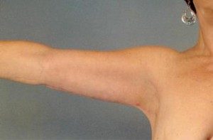 Brachioplasty Before and After Pictures Houston, TX