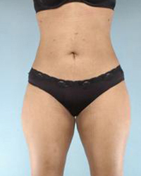 Liposuction Before and After Pictures Houston, TX