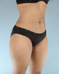 Liposuction Before and After Pictures Houston, TX