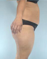 Liposuction Before and After Pictures Houston, TX