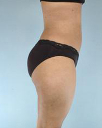 Liposuction Before and After Pictures Houston, TX