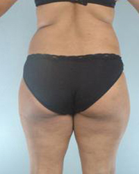 Liposuction Before and After Pictures Houston, TX