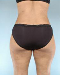 Liposuction Before and After Pictures Houston, TX