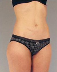 Liposuction Before and After Pictures Houston, TX