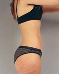 Liposuction Before and After Pictures Houston, TX