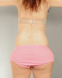 Liposuction Before and After Pictures Houston, TX