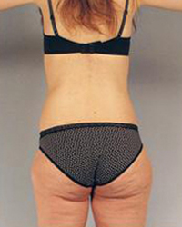 Liposuction Before and After Pictures Houston, TX