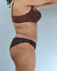 Liposuction Before and After Pictures Houston, TX