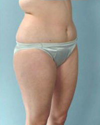 Liposuction Before and After Pictures Houston, TX