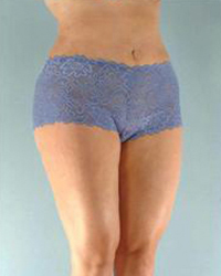 Liposuction Before and After Pictures Houston, TX