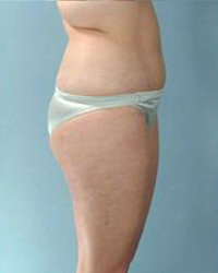 Liposuction Before and After Pictures Houston, TX