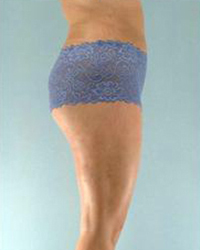 Liposuction Before and After Pictures Houston, TX