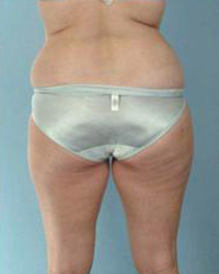 Liposuction Before and After Pictures Houston, TX