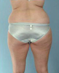 Liposuction Before and After Pictures Houston, TX