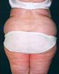 Liposuction Before and After Pictures Houston, TX