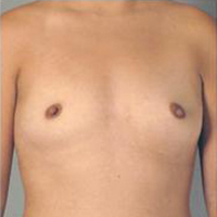 Breast Augmentation Before and After Pictures Houston, TX