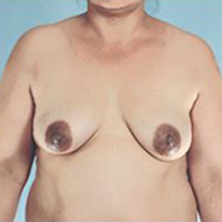 Breast Augmentation Before and After Pictures Houston, TX