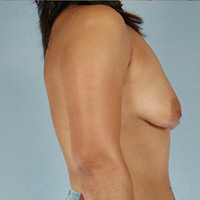 Breast Lift Before and After Pictures Houston, TX