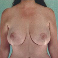 Breast Lift Before and After Pictures Houston, TX
