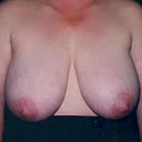 Breast Reduction Before and After Pictures Houston, TX