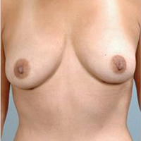 Breast Reduction Before and After Pictures Houston, TX