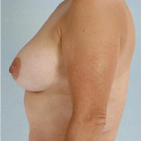 Breast Reduction Before and After Pictures Houston, TX