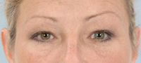 Blepharoplasty Before and After Pictures Houston, TX